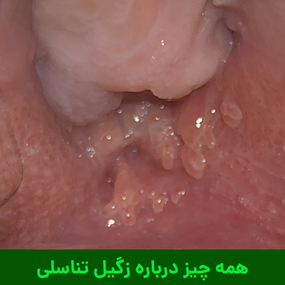 زگیل تناسلی و هزینه درمان آن در سال 1403