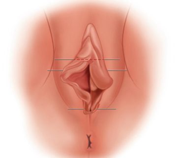 هودکتومی برای زیبایی واژن