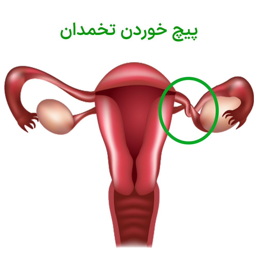 تورشن تخمدان یا پیچ خوردگی تخمدان و درمان آن در تهران