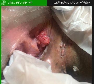 درمان زگیل داخل واژن در تهران