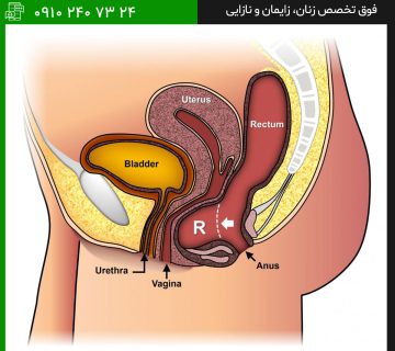 رکتوسل بیماری برای ورم و برآمدگی واژن