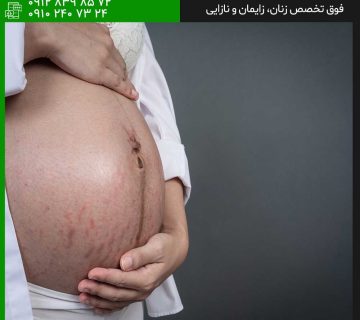ترک پوستی در زمان بارداری