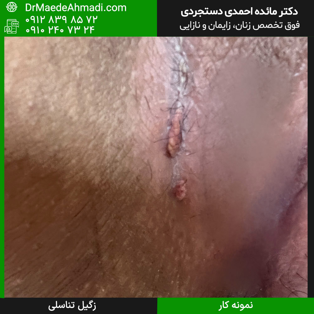 زگیل کنار واژن - نمونه کار 55 زگیل کنار واژن - نمونه کار 55