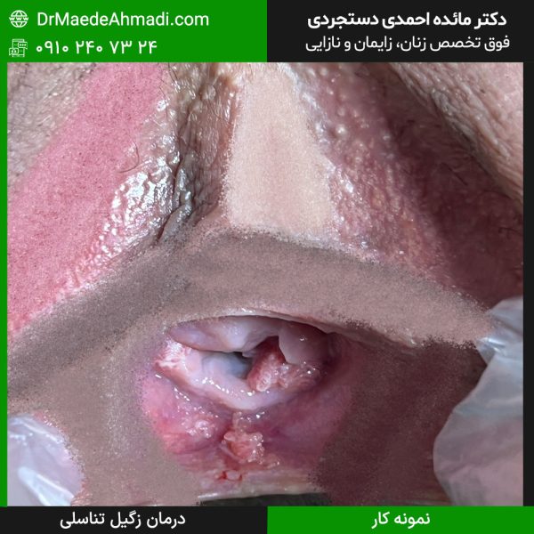 نمونه کارهای درمان زگیل تناسلی در تهران
